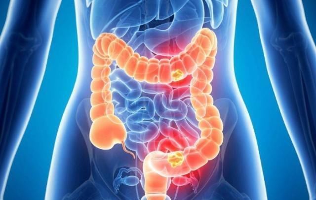 肺里咳出的痰是鼻涕还是毒素,可能大多数人不知道,早知早受益