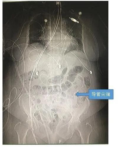 成功率|深圳恒生医院ICU成功开展首例电磁导航下床旁鼻肠管置入术
