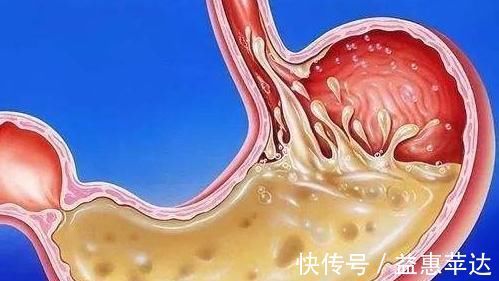 炎症|幽门螺杆菌呈阳性，坚持三件事，炎症可能会慢慢消除，胃也健康了