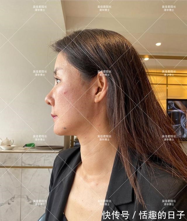 线雕 44岁小拉皮术后5个半月,用亲身经历谈一谈我的感受!