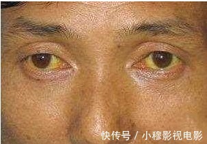 高龄|高龄老中医:肝出了问题, 基本都是肝癌晚期了,3大信号: 手上、脸上、嘴里全都有