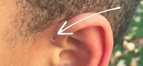 新妈妈|宝宝耳朵有“聪明孔”,妈妈忍不住挤了一下,医生摇头动手术吧