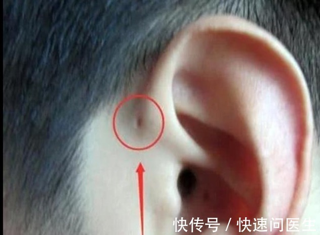 患儿|新生儿耳朵旁边有个小孔，是富贵、聪明的象征？其实是先天性畸形