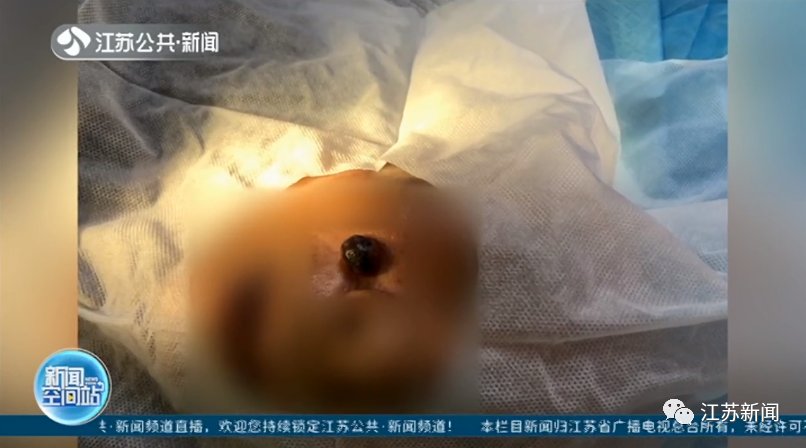 基底细胞癌|男子脸上痣突然增大，一查竟是癌！医生：一旦有这个信号就要警惕了