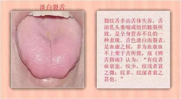 舌诊|中医医生总看舌头都在看什么九种体质+珍贵的舌诊图谱