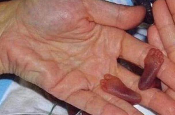 诊断|"拇指姑娘"出生时仅25厘米,被诊断活不到1岁,结果却出人意料