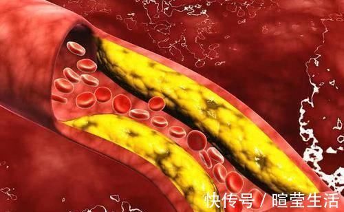 营养物质|甘油三酯降不降看日常生活三点做绝不绝,血脂正常不是问题