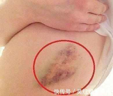 白血病|身体如果出现3种现象,说明癌症可能找上你了,尽早检查