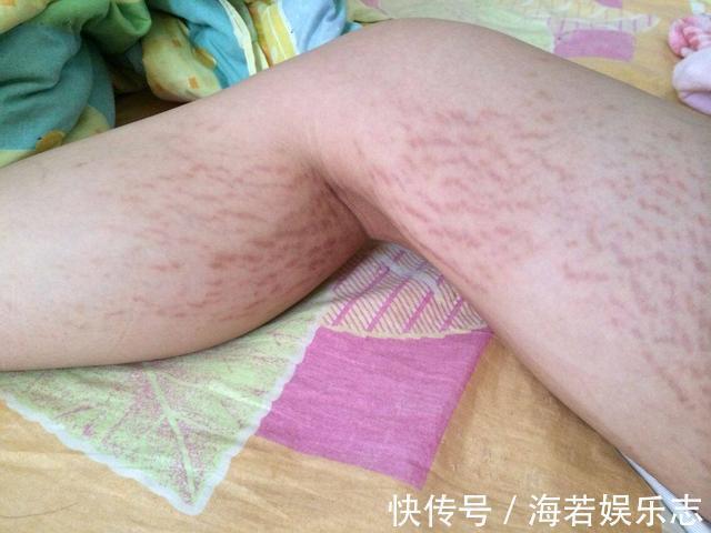 孕期|羡慕怀孕后妊娠纹不会找3种孕妈,来看看你在里面吗