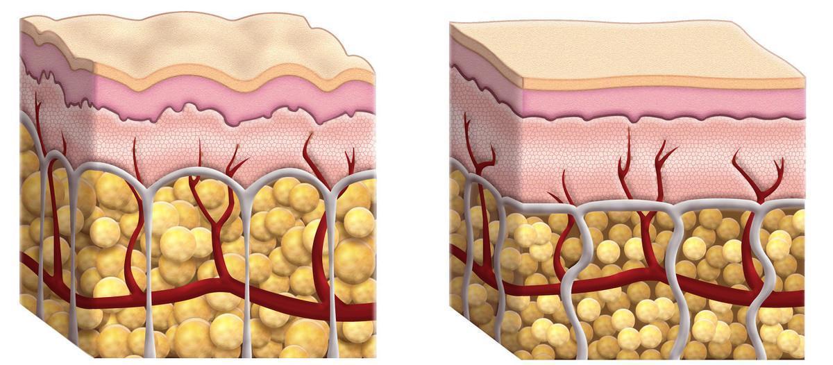 恶性|肿瘤未分化、低分化、中分化、高分化是什么意思?哪个类型最严重