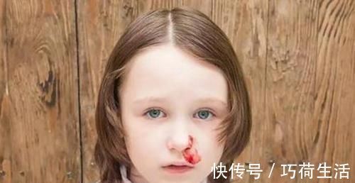 鼻出血|宝宝容易流鼻血,父母不要再用纸巾塞鼻孔了,用其它的方法止血