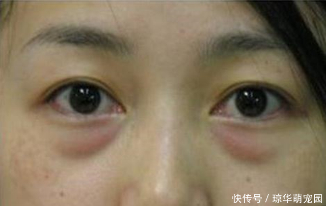 怎样祛眼袋？中医还真有办法，支你3招，一招比一招强，女性要看
