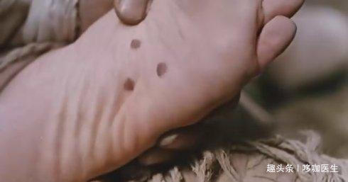 粘膜|60岁大爷抠手患癌,医生提醒手欠会诱发癌症