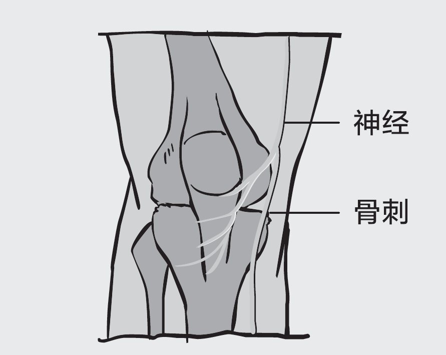 关节|如何才能把骨刺消掉？