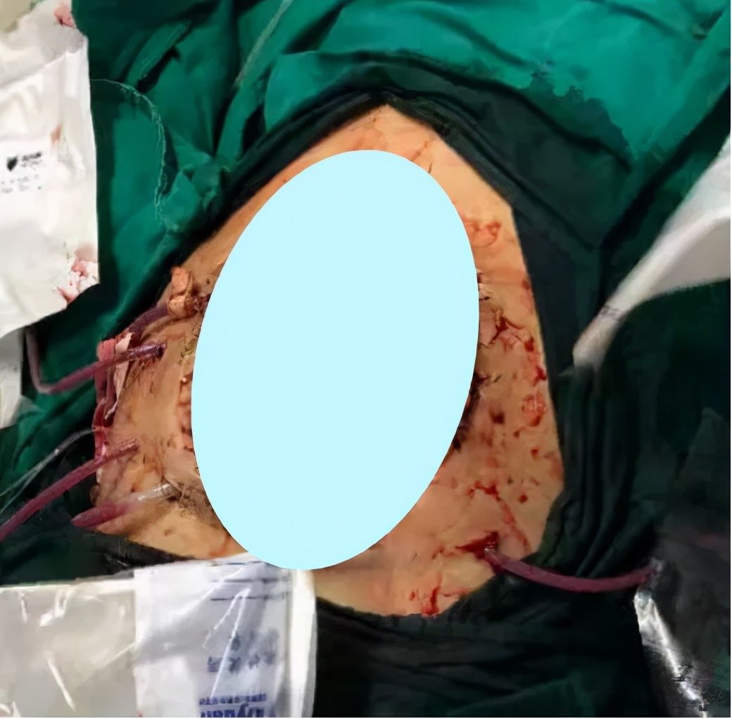 致命腹痛|致命腹痛，让中年大叔遭遇九死一生！“开膛破肚”进医院，还能救活吗？