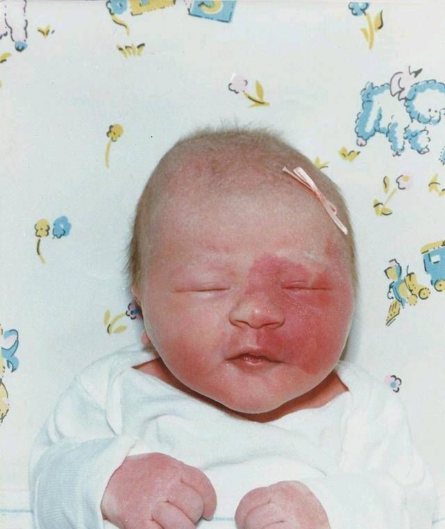 胎记|宝宝出生时脸上有胎记胎记是如何形成的注意怀孕