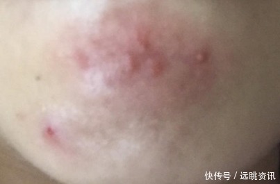 白色|下巴处冒出的白色小疙瘩,看过去连成一片,多半是因为螨虫撕咬!