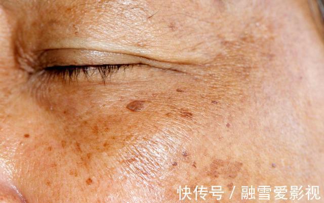 雌激素|女人“黄体酮”不足会长斑?常吃3种食物,补充雌激素,分解色斑