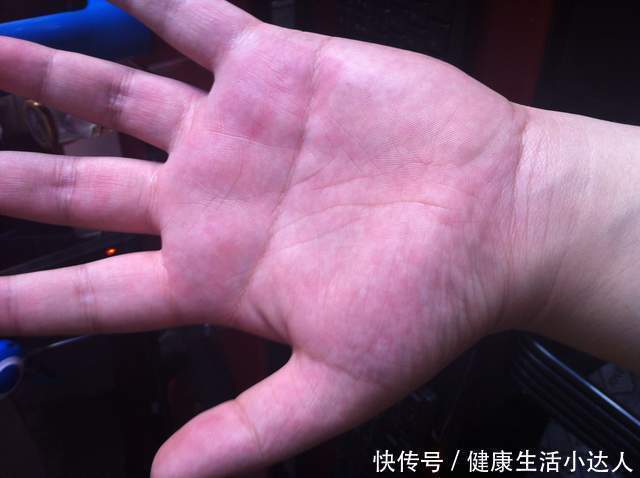 食物|血脂高，“手”知道，若手部出现这5个表现，赶紧查一下血脂