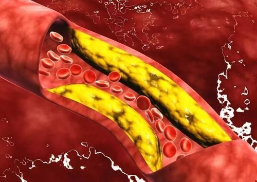 高血压患者，需要“滴酒不沾”吗？医生：可能多数人不太了解