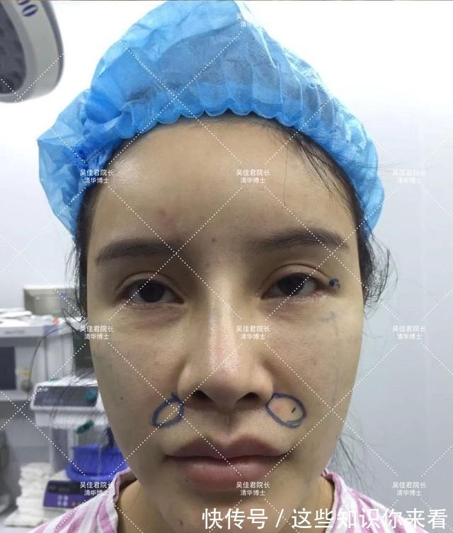 姑娘 32岁姑娘小拉皮术后7个半月,变得年轻又精致,前后反差很大!