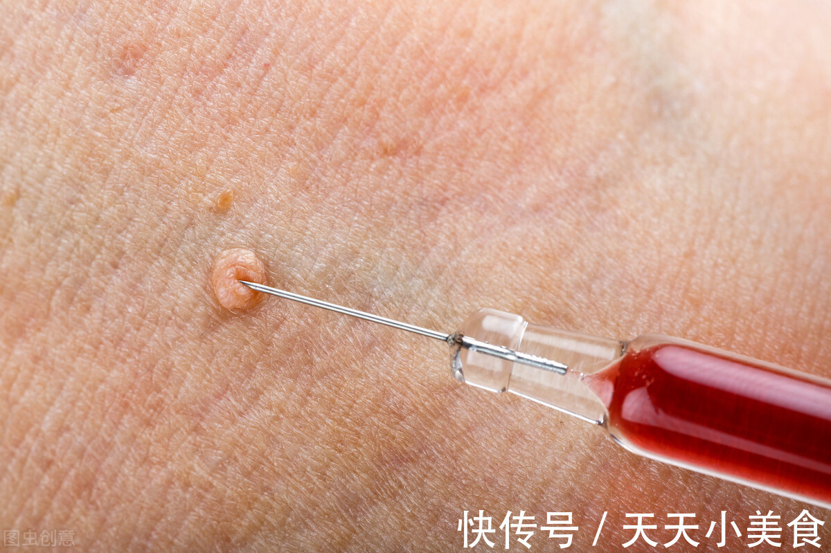 hpv|身体3异常“迹象”表明宫颈受损，或已感染HPV，及时检查远离病变