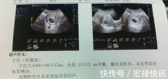 b超|孕45天发现怀孕，孕妈尽快进行这项检查，了解这些情况很重要