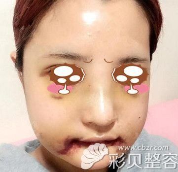 了面部磨骨、削骨手术失败后遗症有哪些?