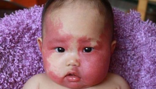 产科医生|胎记是怎么回事产科医生孕期尽量避开3种行为,以免胎儿自卑