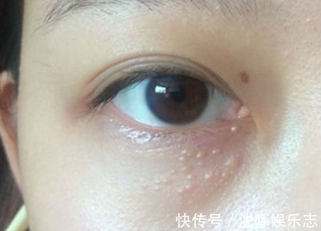 眼角|眼角的脂肪粒怎么消除教你2招,不用针挑也不用手抠,轻松消除