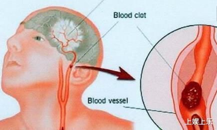 身体出现3种症状，或是血栓的表现，建议多做2事，或对血管有好处