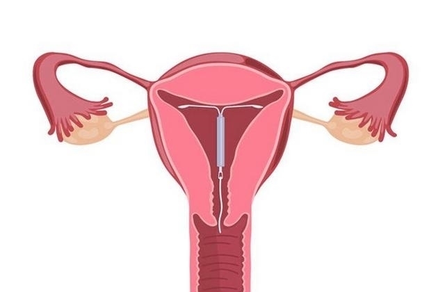 避孕|生完二胎后，女人需要“上环”吗？看完以后或许会有答案！