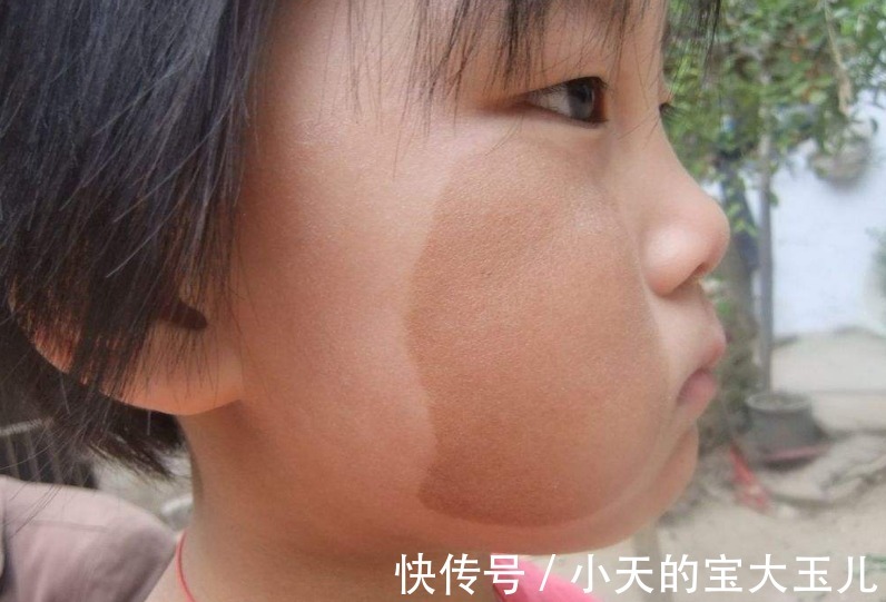 化妆品|婴儿身上为什么会有胎记？资深医生说出原因，与“孕期行为”有关