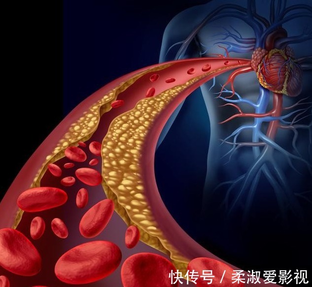 优质蛋白|高血脂是吃出来的?坚持“两低一高”饮食,2个月轻松吃掉高血脂