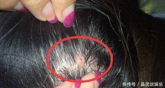 油脂|头皮上长出“小疙瘩”,可能是有大问题,为了家里人健康了解下!