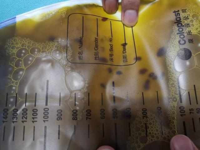  穿刺胆道|吓人男子胆汁里竟发现虫子只因吃了这个……