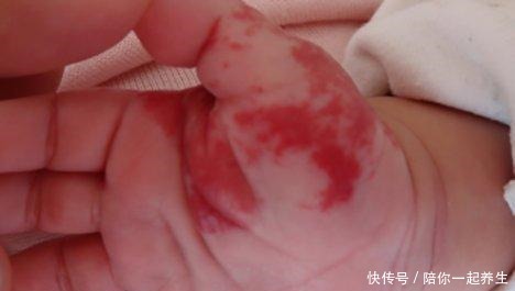 新生儿手臂生出“草莓斑”,宝妈以为碰了,医生检查后说要手术!