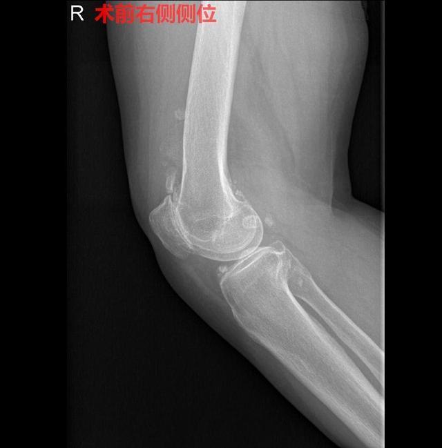 老太太|60岁老太太右膝痛了20年,一直治标不治本,结果查出这些问题