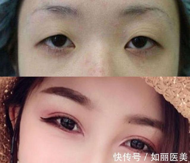 重睑 什么是割双眼皮呢?割双眼皮手术都包含哪些项目?你都了解吗