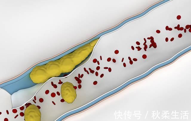 血管|脑梗发作只需21秒，医生有这3个习惯，血管不堵，脑梗不敢来
