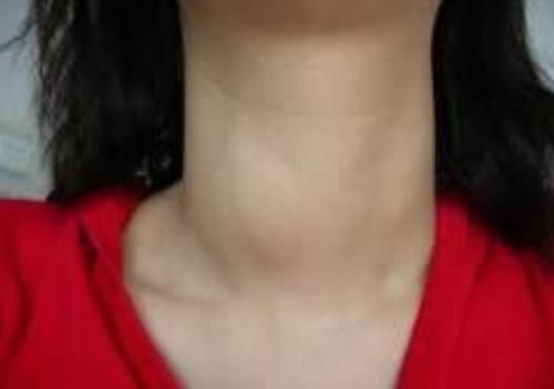 乳腺疾病|甲状腺结节的“克星”找到了,经常吃,化瘀散结,结节悄悄变小!