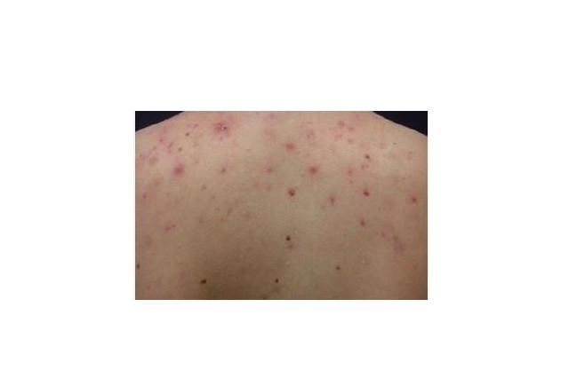 后背上长很多“小米粒”，如何消除？简单三招还你光洁亮丽的后背