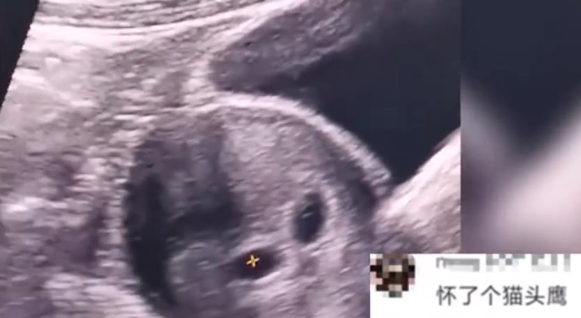 生长发育|男子得知妻子怀上双胞胎,激动得语无伦次,网友看完B超:外星人