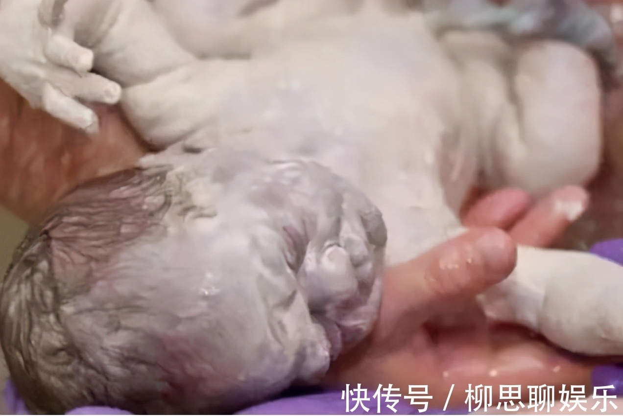 宝宝|95后宝妈生下“雪人宝宝”,全家吓得没人敢抱,医生却说恭喜了