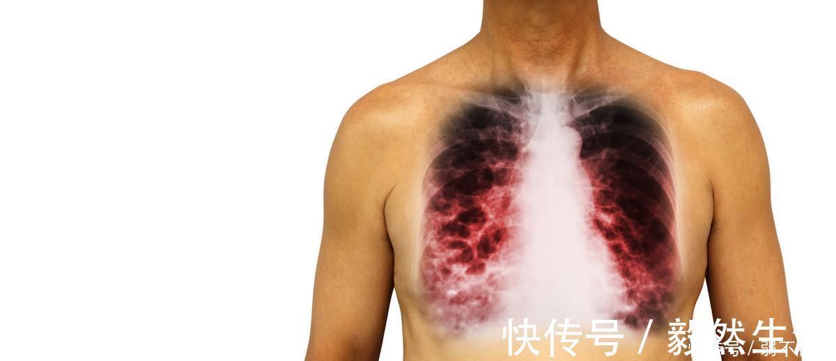 骨痛|吸烟者，身体一旦出现“1大2痛”，八成是肺癌上身，具体指什么