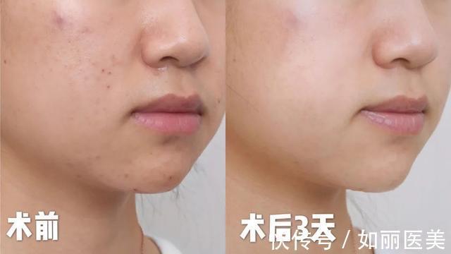 皮肤 想要皮肤好,医美还是护肤品?光子嫩肤的体检报告