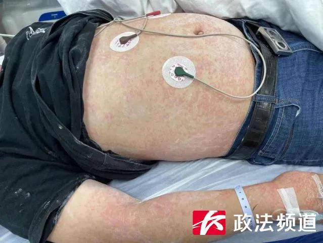 icu|这种家中常备药别乱吃！男子自服一粒后住进ICU