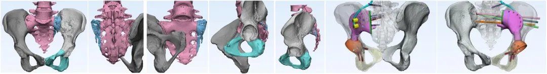 3D打印|柳州58岁阿姨肠癌十多年后又患巨大骨肉瘤，医生“精准拆弹”利用3D打印重建骨盆假体
