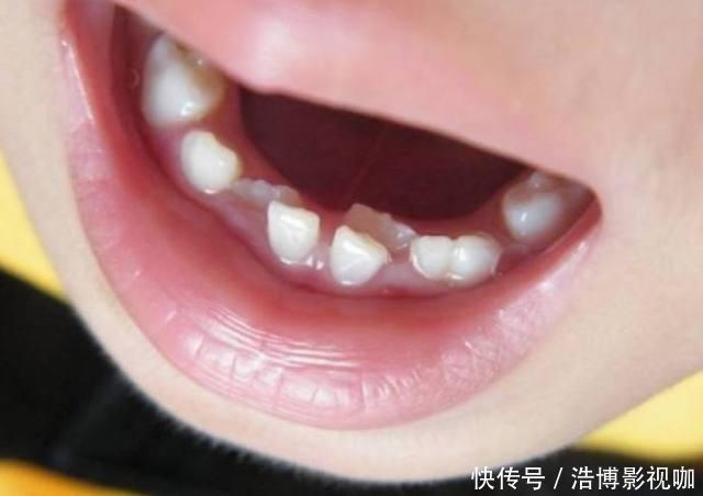 家长|为何现在“双排牙”的孩子越来越多医生跟家长脱不了干系！