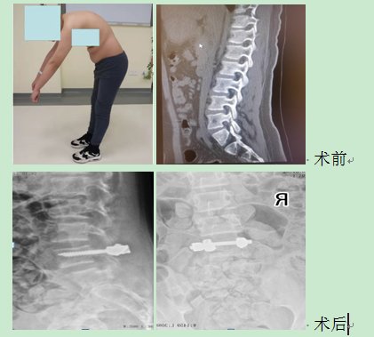 椎体|骨科：成功开展椎弓根螺钉-棒-张力带固定手术